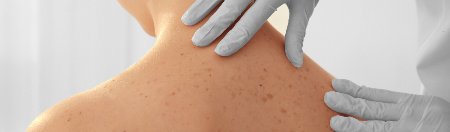 Frau mit vielen Muttermalen beim Hautcheck